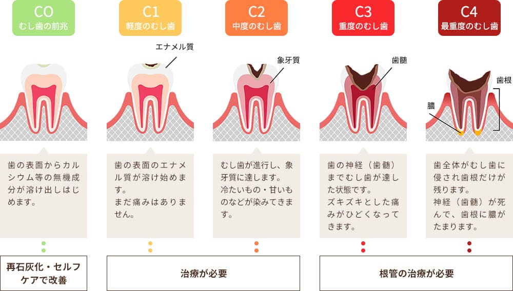 むし歯の進行と症状
